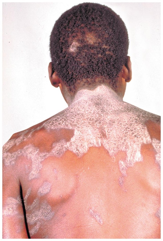 Inflamed skin (dermatitis) can result from pellagra