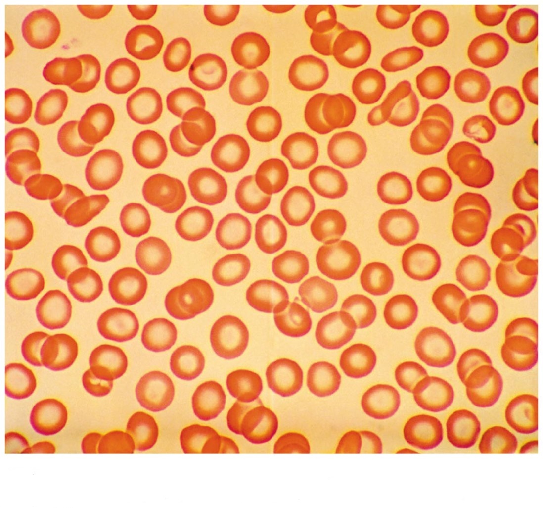 Anemic Red Blood Cells