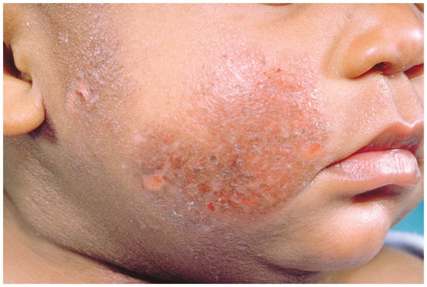 Skin rash is one of the symptoms of zinc deficiency