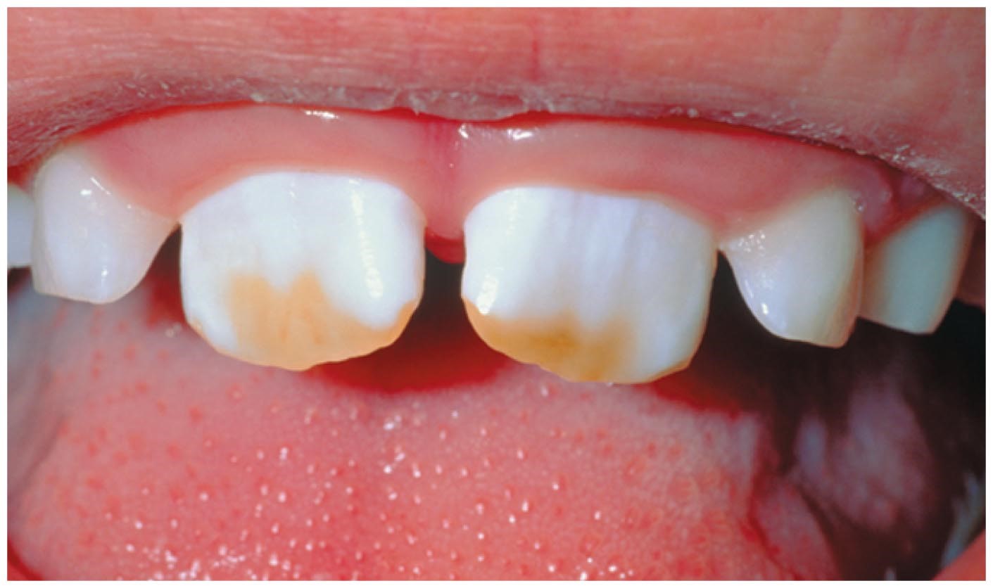 Teeth pitted by fluorosis