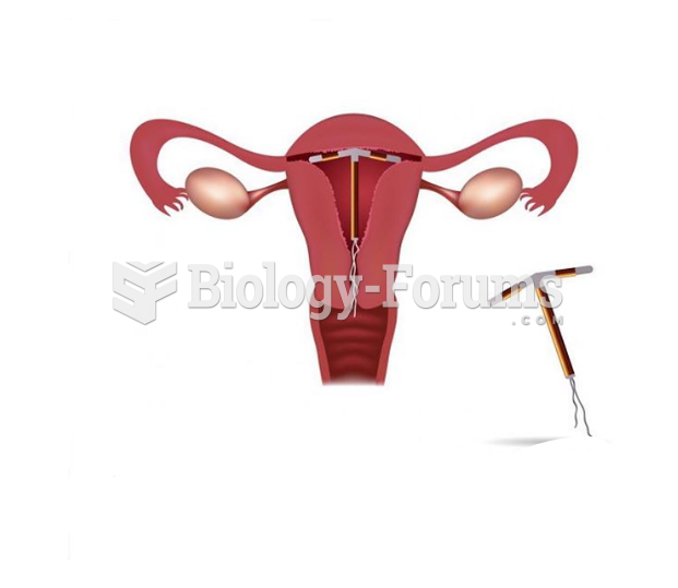 IUD to prevent pregnancy اللولب النحاسي  لمنع الحمل