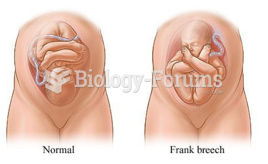 Normal vs. Frank Breech