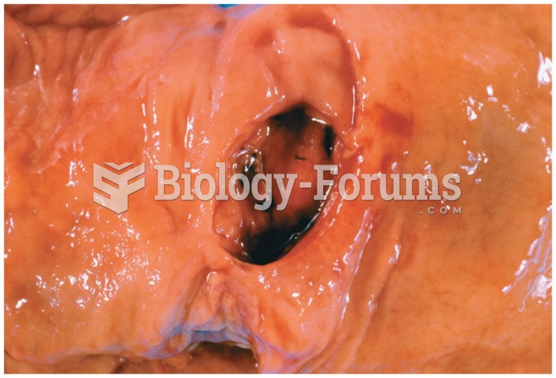 An ulcer is created when the mucosal lining of the GI tract erodes or breaks