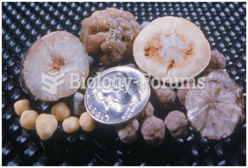 Gallstones result from the crystallization of salts and other compounds in bile