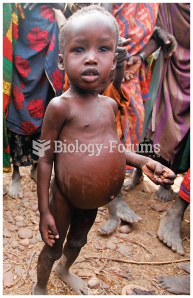 Kwashiorkor The edema in this child’s belly is a classic sign of kwashiorkor