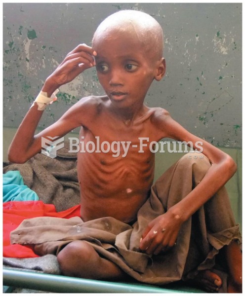 Marasmus The emaciated appearance of this child is a sign (and symptom) of marasmus