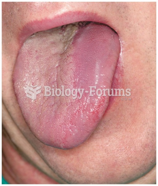 An inflamed tongue (glossitis) is one symptom of a riboflavin deficiency