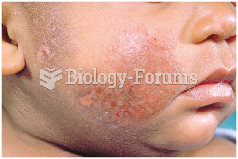 Skin rash is one of the symptoms of zinc deficiency