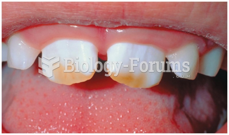 Teeth pitted by fluorosis