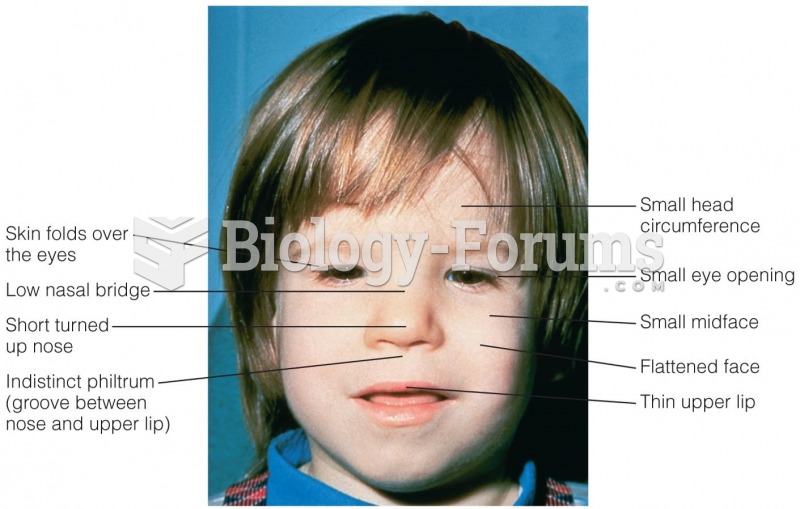 Fetal Alcohol Syndrome Children born with fetal alcohol syndrome often have facial abnormalities