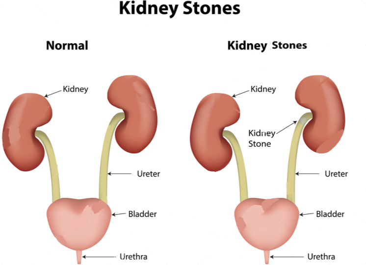 Have you ever experienced a kidney stone before?