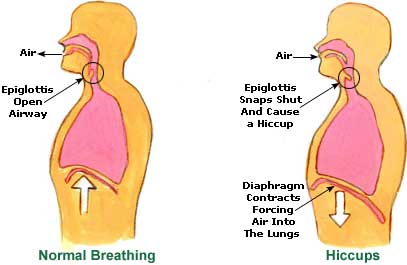 What Causes Hiccups?