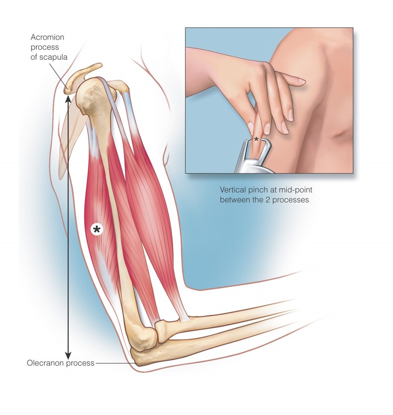 Landmarks for tricep skinfold measurement