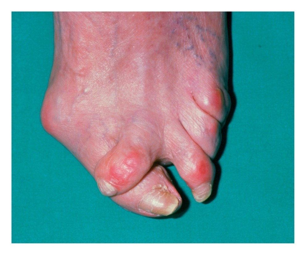 Hallux valgus