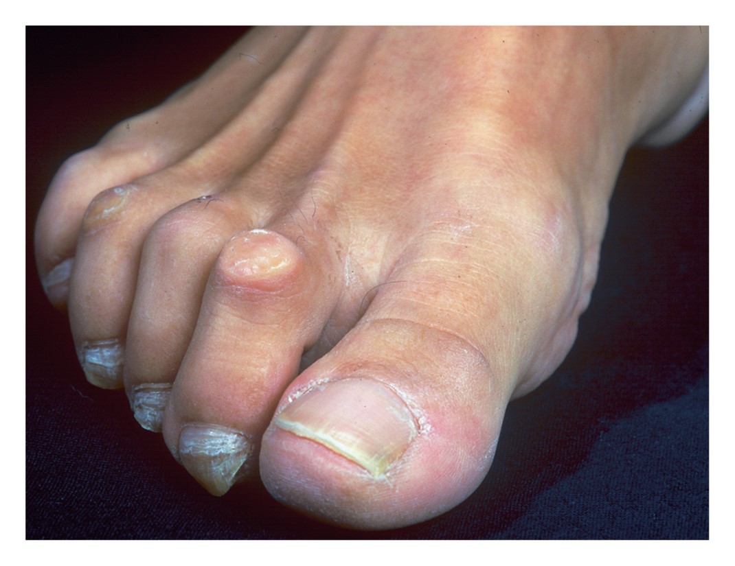 Hammertoe