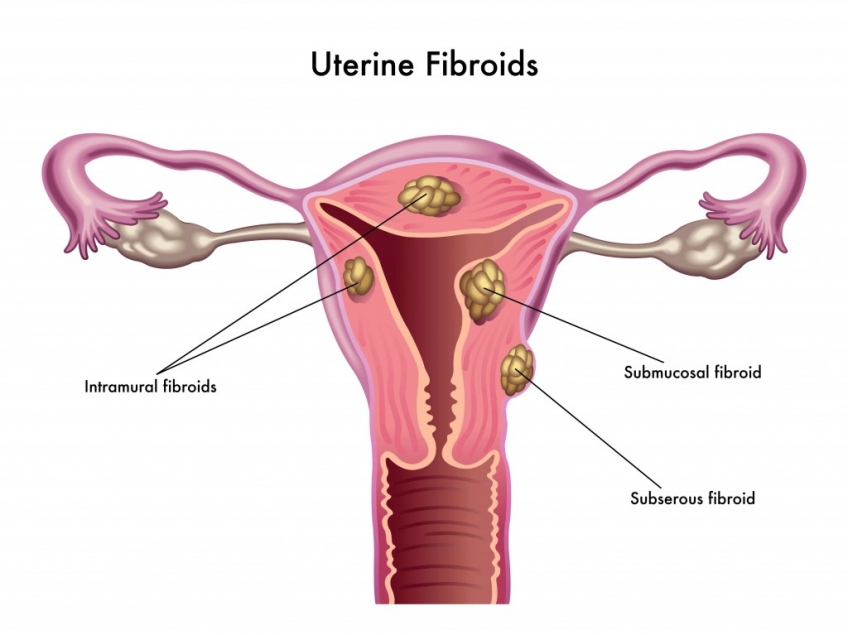 Uterine Fibroids