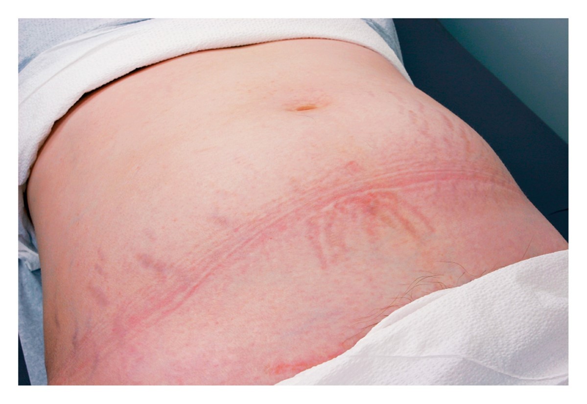 Integumentary changes in pregnancy: Striae