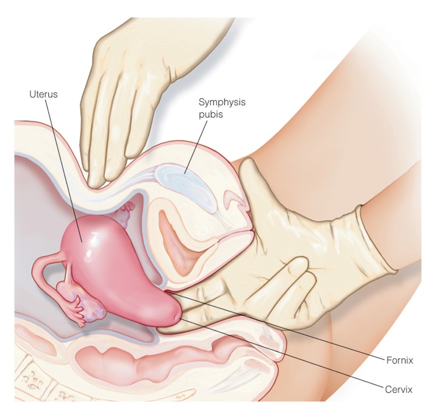 Bimanual palpation of the uterus