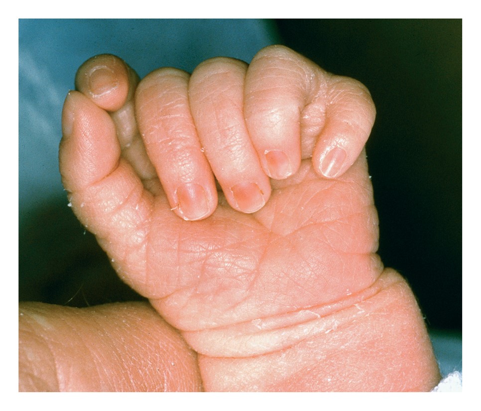 Polydactyly