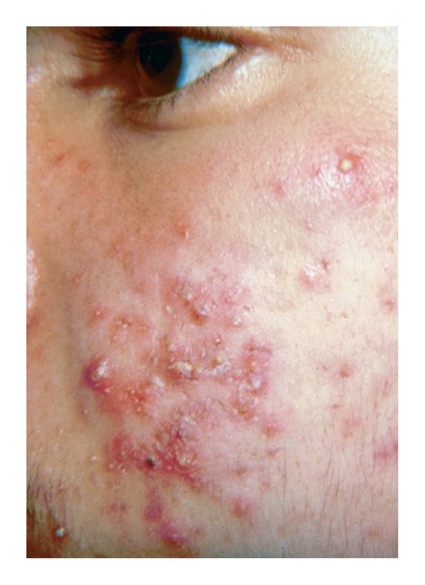 Open and closed comedones of acne