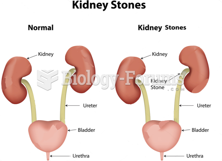 Have you ever experienced a kidney stone before?