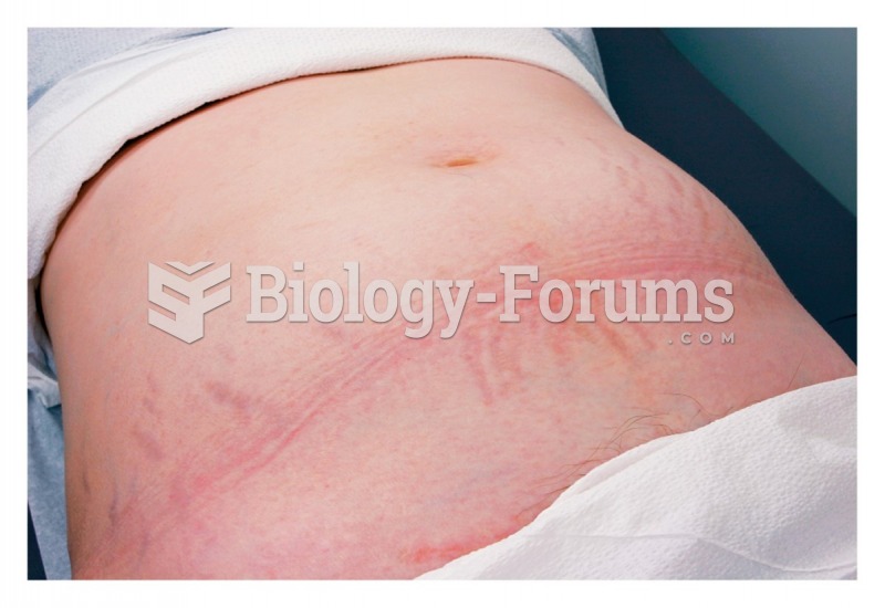 Integumentary changes in pregnancy: Striae