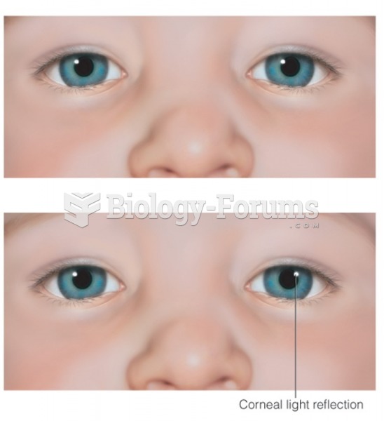 Normal and abnormal corneal light reflection test