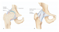 Hip joint