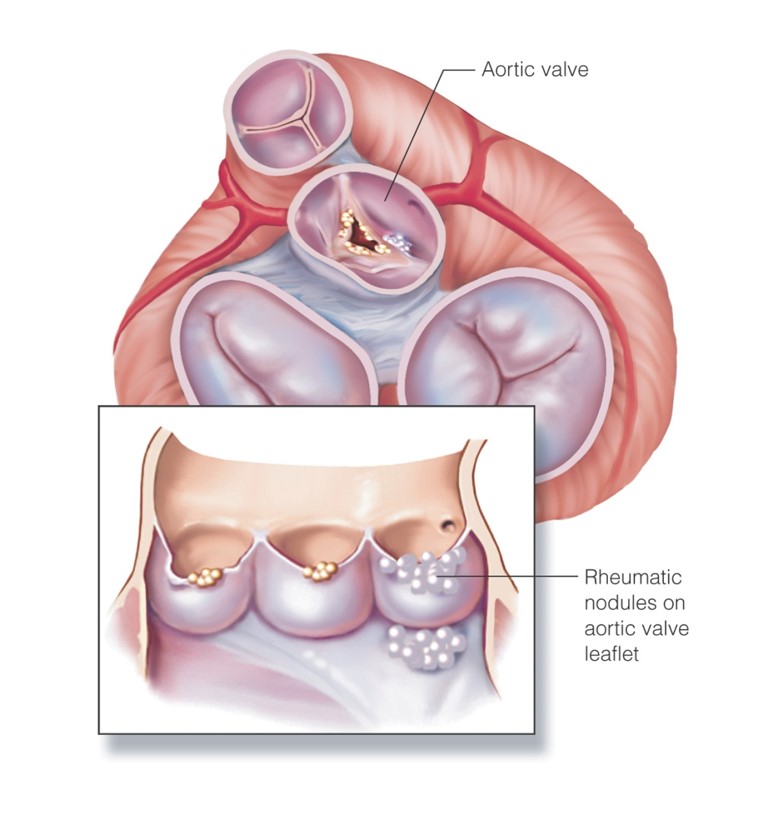 Aortic stenosis