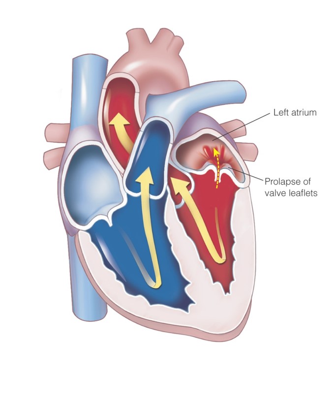 Mitral valve prolapse