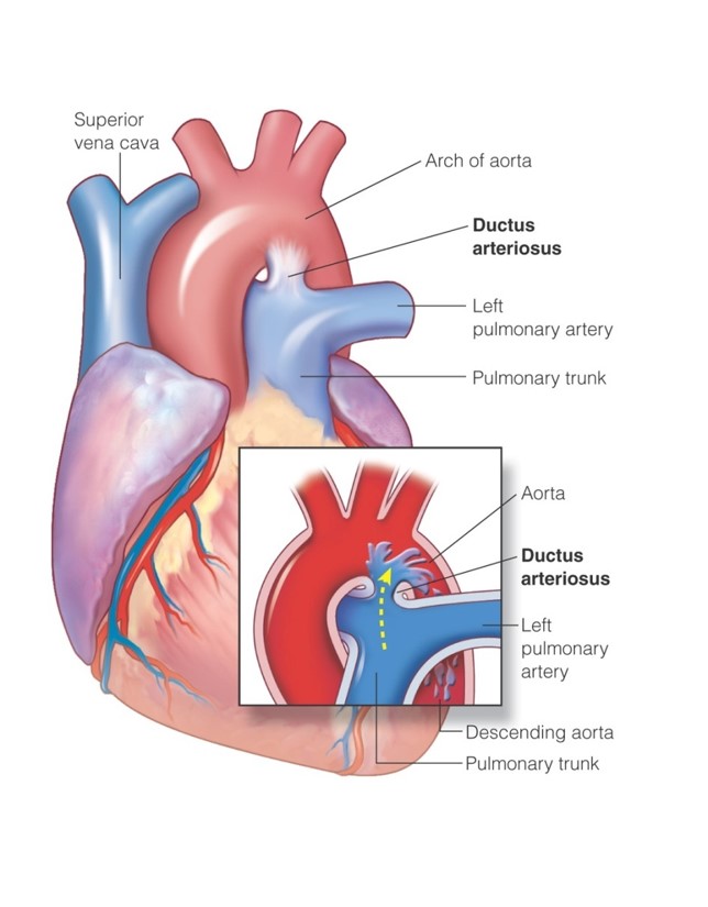 Patent ductus arteriosus