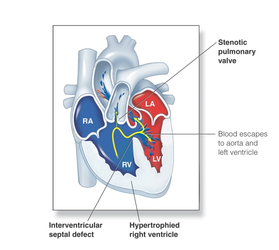 Tetralogy of Fallot