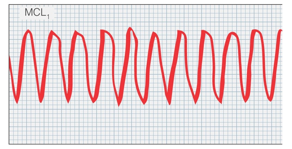 Ventricular tachycardia