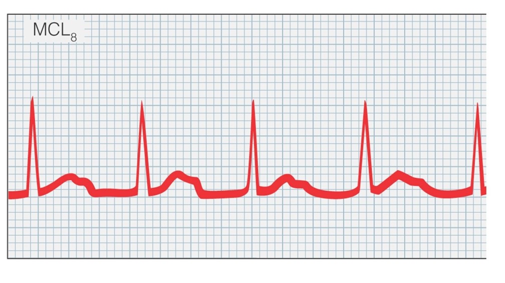 Heart block