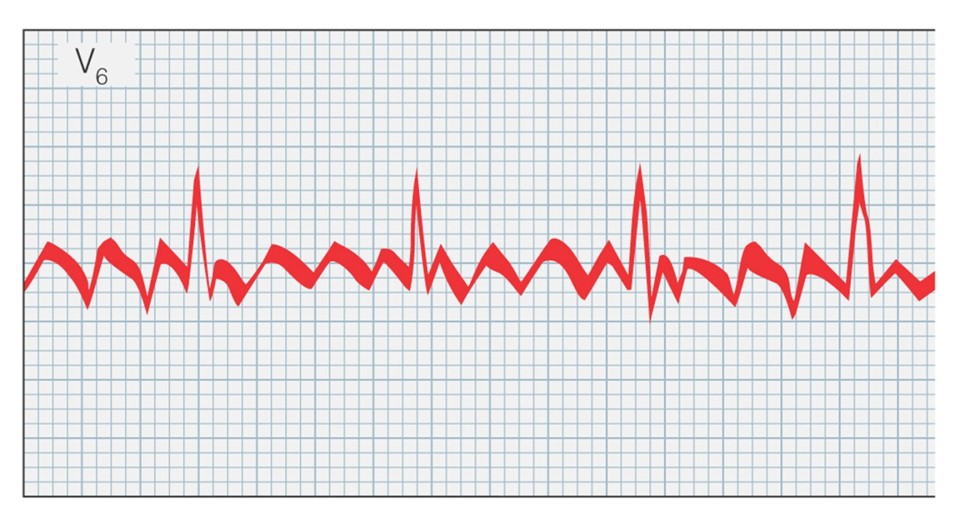 Atrial flutter