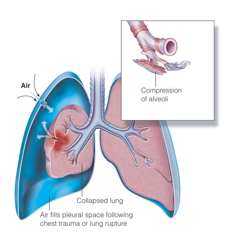 Pneumothorax