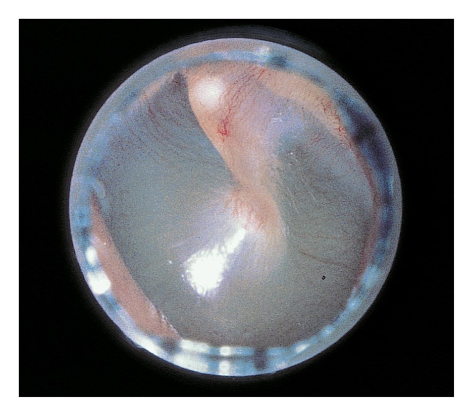 Normal tympanic membrane with cone of light and process of malleus