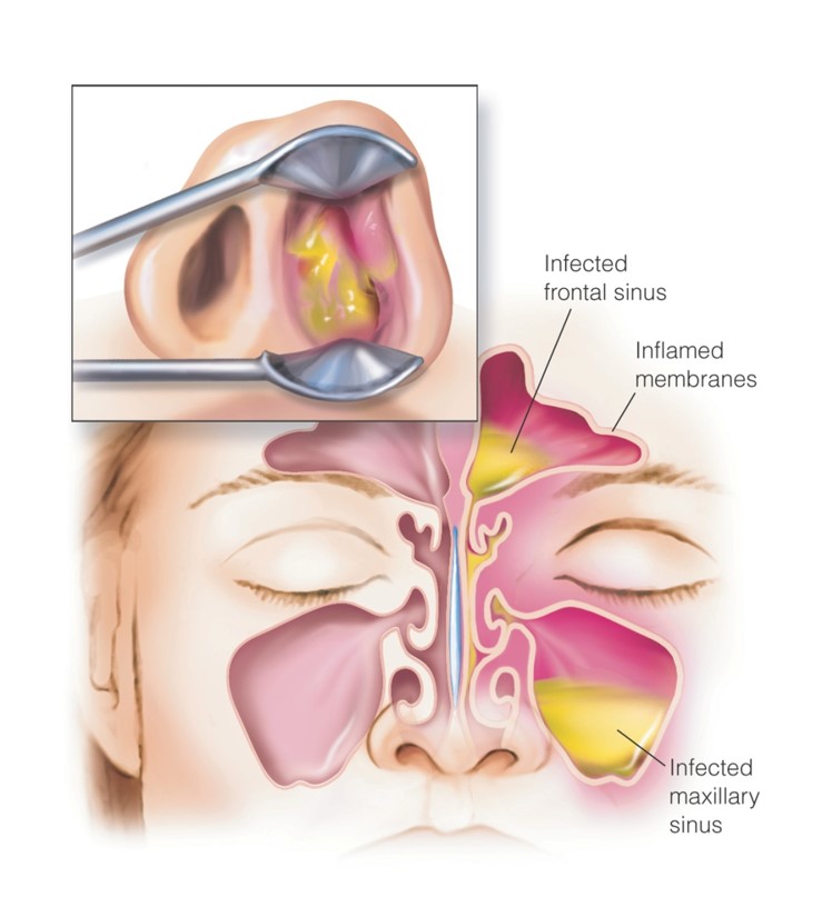 Sinusitis