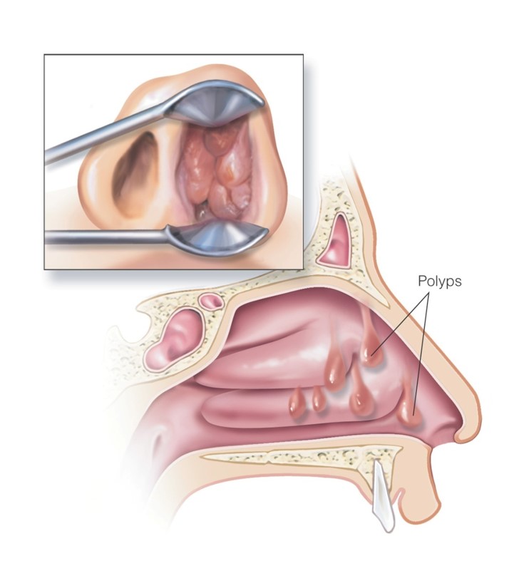 Nasal polyps