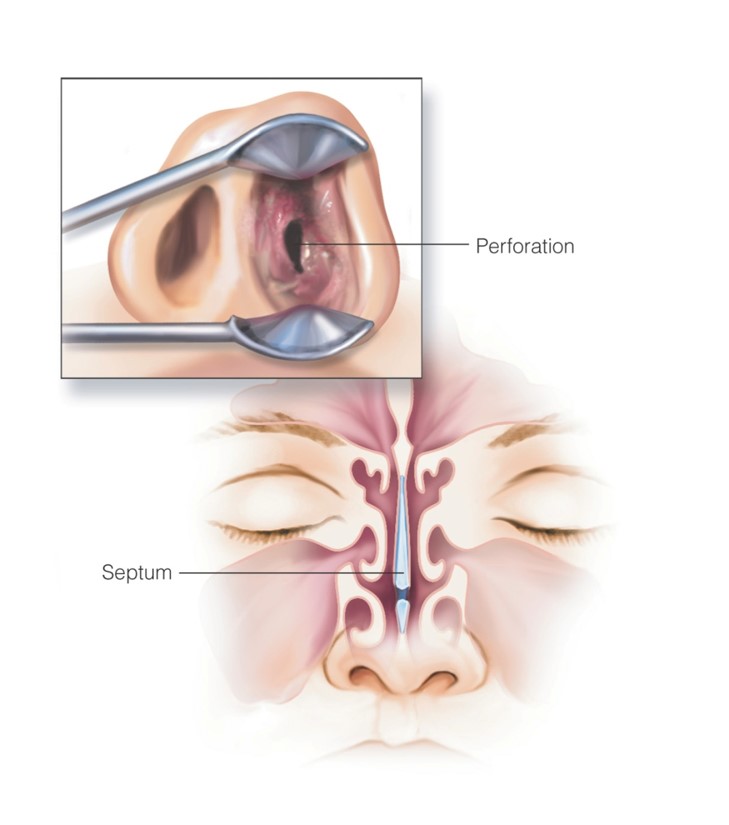 Perforated septum