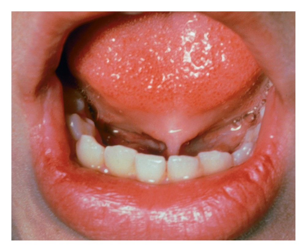 Ankyloglossia