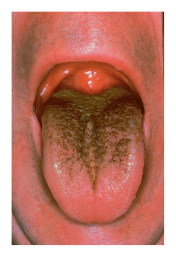 Black hairy tongue