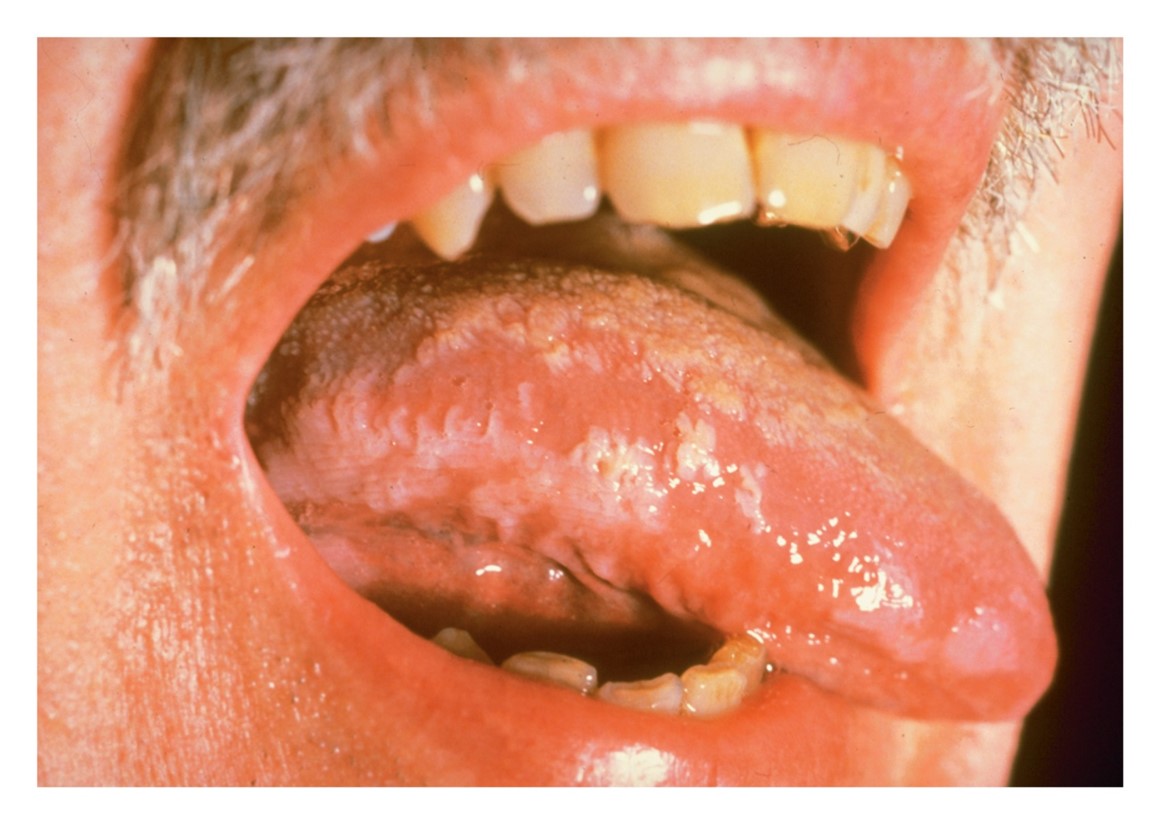 Leukoplakia