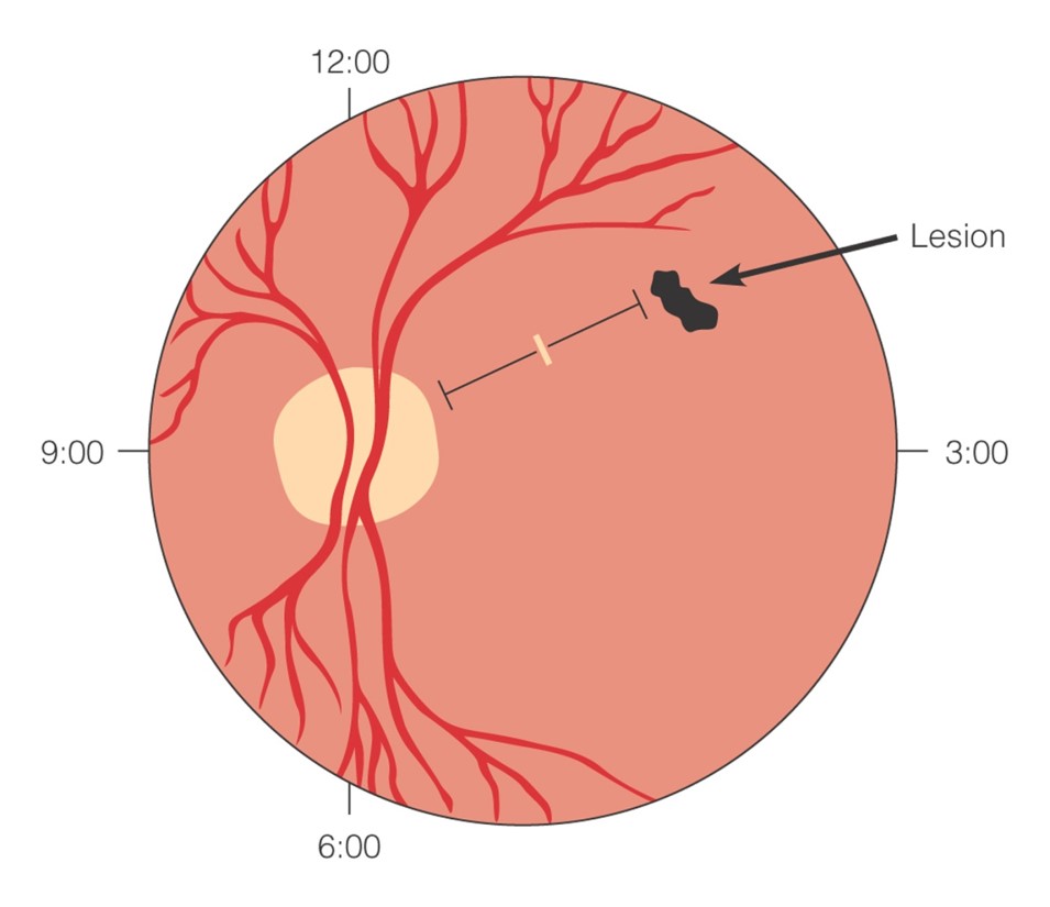 Documenting a finding from the ophthalmoscopic examination