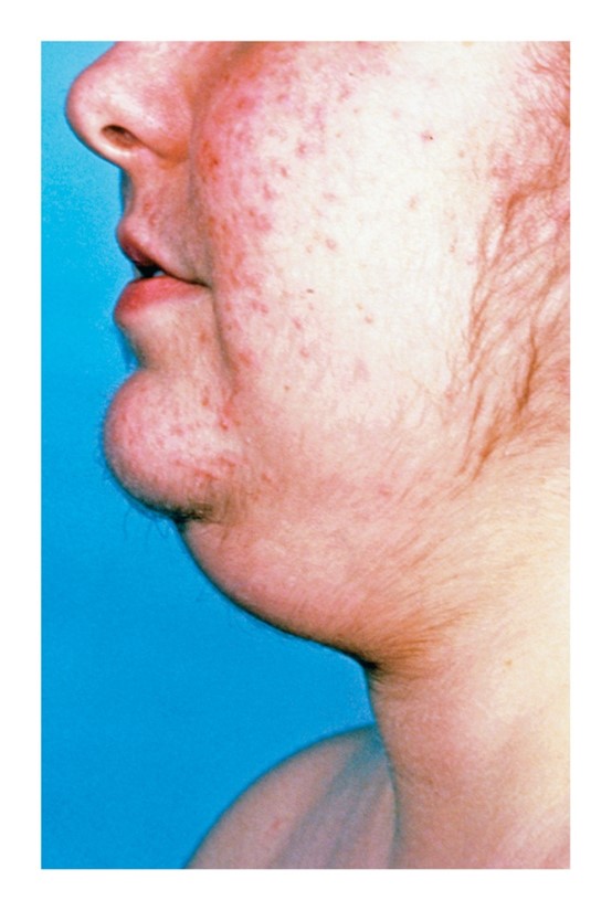 Cushing’s syndrome