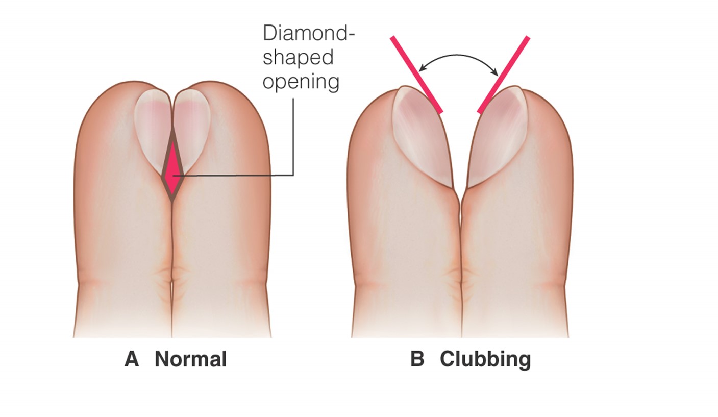 Schamroth test  A.  Healthy nail  B.  Clubbing