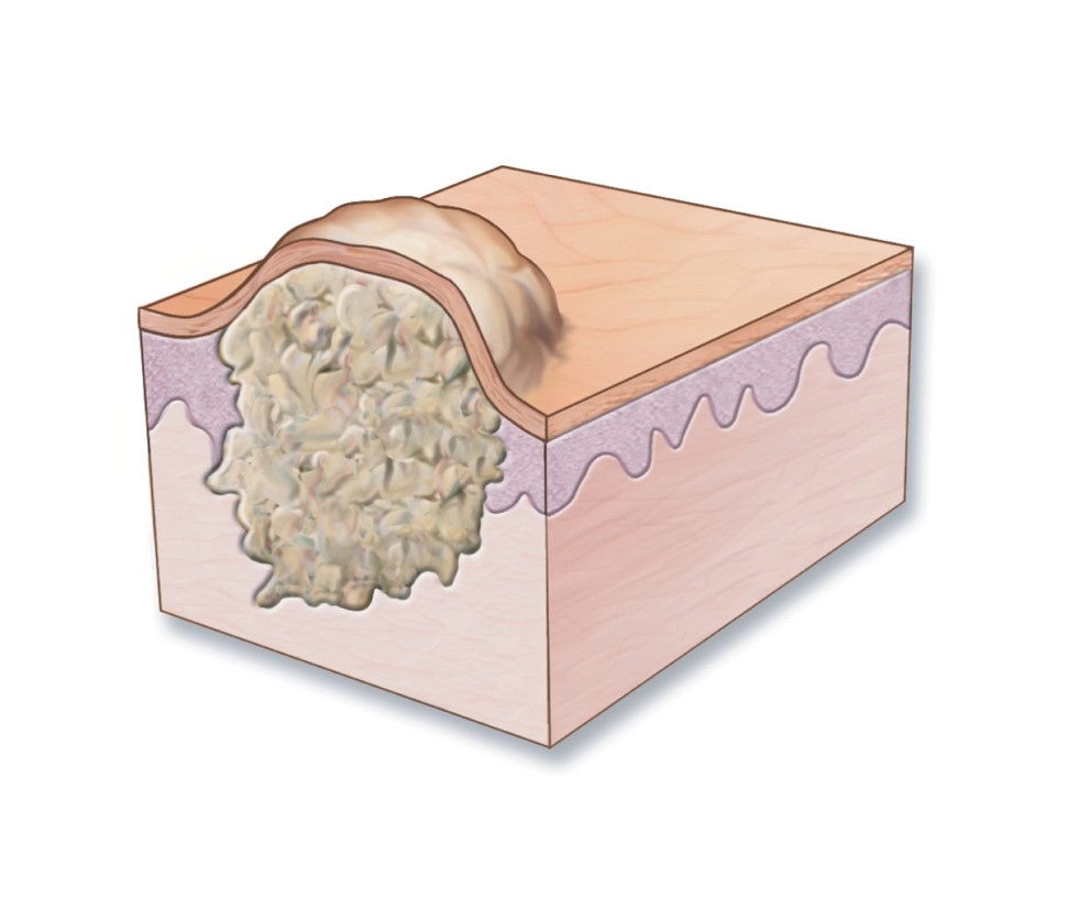 Nodule, tumor