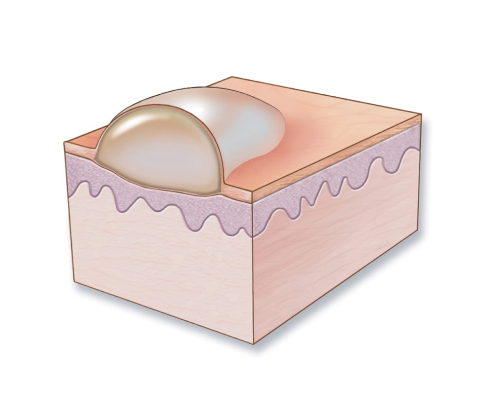 Vesicle, bulla