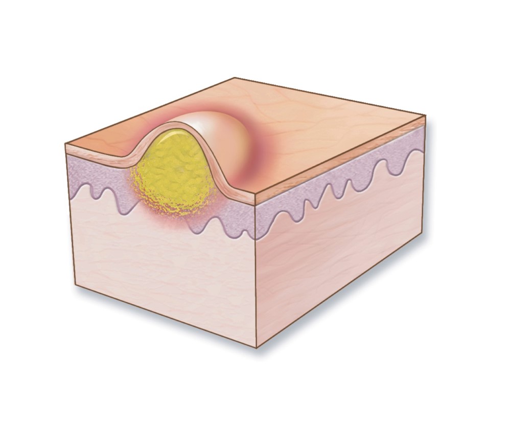 Pustule