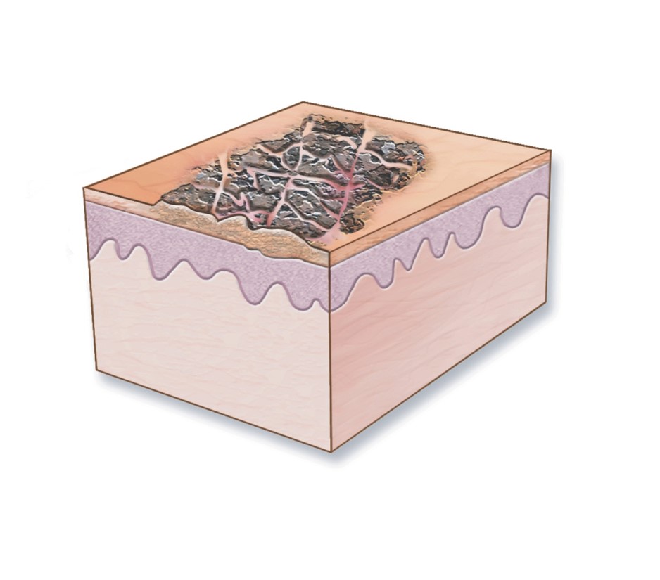 Lichenification